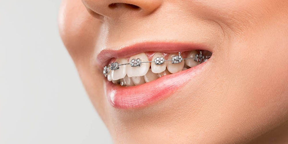 Tratamento Ortodontico