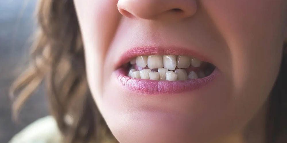 Como corrigir dentes tortos, acavalados – sobrepostos ou apinhados?