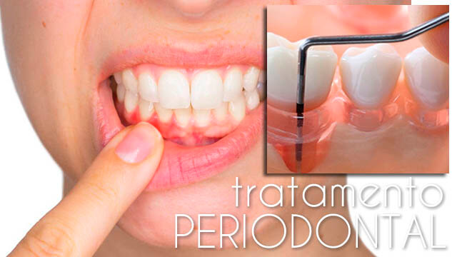 Tratamento Periodontal