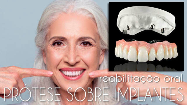 Reabilitação Oral - Prótese Sobre Implantes