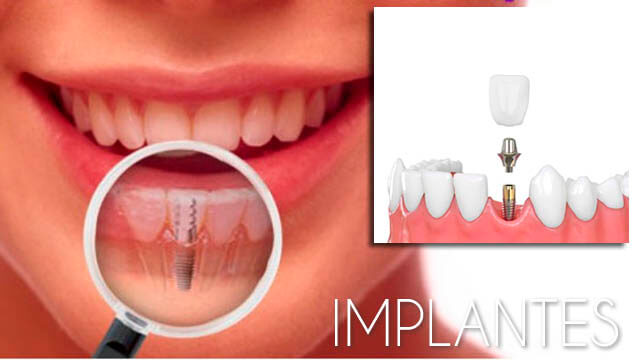 Implantes