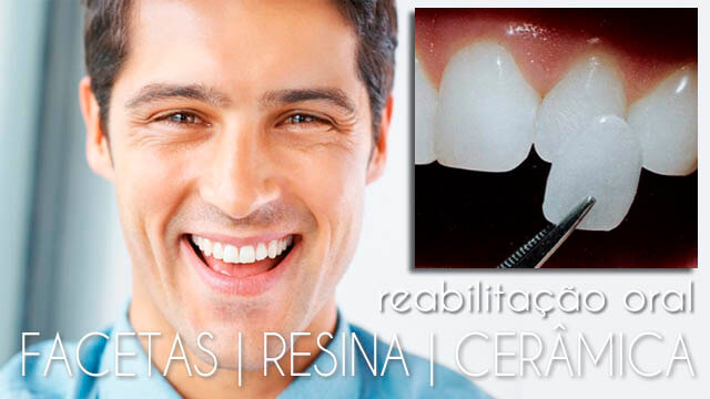 Reabilitação Oral | Facetas | Resinas | Cerâmica